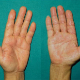 DRESS Syndrome Induced by Telaprevir: A Potentially Fatal Adverse Event in Chronic Hepatitis C Therapy