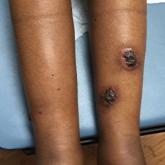Rupioid Psoriasis and Psoriatic Arthritis in a Patient With Skin of Color
