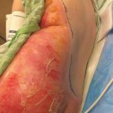 Symmetric Drug-Related Intertriginous and Flexural Exanthema