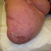 Stump Pemphigoid