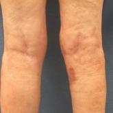 Nephrogenic Systemic Fibrosis in the Setting of Transient Renal Insufficiency