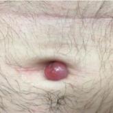 A 15- to 20-mm, shiny, friable-appearing, red umbilical nodule