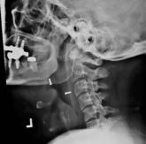 Flu or strep? Rapid tests can mislead