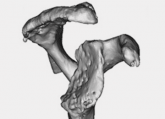 Shoulder Arthroplasty in Cases of Significant Bone Loss: An Overview Shoulder Arthroplasty in Cases of Significant Bone Loss: An Overview