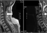Spontaneous Cervical Spinal Epidural Hematoma 