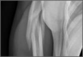 Thrower’s Fracture of the Humerus