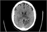 Atypical Acute Myocardial Infarction and Concomitant Acute Cerebral Infarct