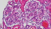 Anti-Tumor Necrosis Factor Treatment for Glomerulopathy: Case Report and Review of Literature