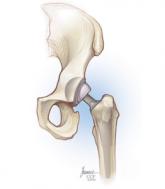 Acute kidney injury after hip or knee replacement: Can we lower the risk?
