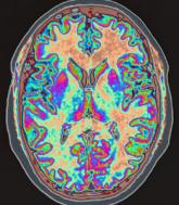 Is neuroimaging necessary to evaluate syncope?