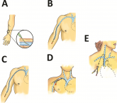 Navigating Venous Access