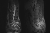 Evaluation of Spinal Epidural Abscess