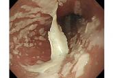 Dabigatran-induced esophagitis