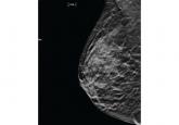 Common benign breast concerns for the primary care physician