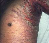 Desquamating pustular rash