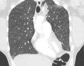 Lung complications of prescription drug abuse