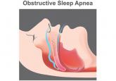 A sleeping beast: Obstructive sleep apnea and stroke