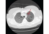 Disseminated invasive aspergillosis in an immunocompetent patient