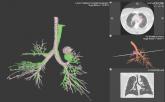 Pulmonary Perspectives® New Technology Enhances Electromagnetic Navigation Bronchoscopy