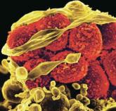 MRSA patients report signs of stigma tied to illness