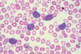 Three-drug regimen boosts progression-free survival in patients with relapsed CLL and adverse prognostic features