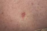 Annual U.S. incidence of BCC pegged at 2 million