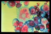 HCV risk sixfold higher with HIV