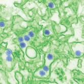 Zika virus in pregnancy linked to hydrops fetalis