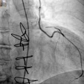 Hybrid revascularization shows promise, but there are concerns