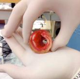 Recent active asthma raises AAA rupture risk