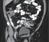 AGA updates guidelines for management of acute diverticulitis