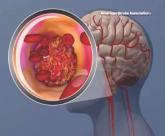 New composite measure improves warfarin anticoagulation monitoring