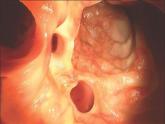 Early elective colon resection common in diverticulitis