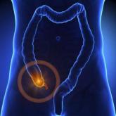 Antibiotic therapy an option for acute appendicitis