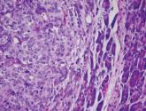 Nab-paclitaxel marginally superior to dacarbazine for metastatic melanoma