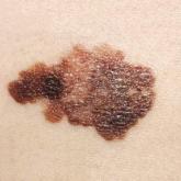 Melanoma twice as likely after CLL/SLL than other types of NHL