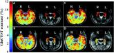 Glutamate-based neuroimaging identifies epileptic foci