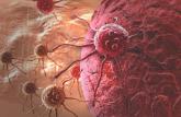 ASCO: Overall survival similar regardless of distant relapse site in breast cancer