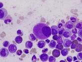 CML patients die from comorbidities, not leukemia