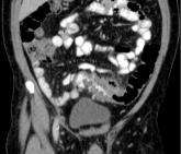 Lavage does not reduce severe complications in perforated diverticulitis