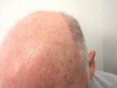 Simultaneous equal to sequential treatment for actinic keratoses