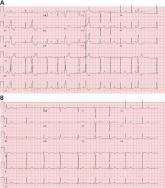 Evaluation and management of premature ventricular complexes
