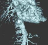 Low mortality, good outcomes in octogenarian AAA repair sparks QOL vs. utility debate