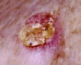 Average person with atopic dermatitis has no increased risk of actinic keratosis or nonmelanoma skin cancer