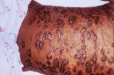 Severe psoriasis upped lymphoma risk in large cohort study
