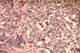 Obesity boosts postmenopausal breast cancer risk
