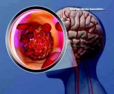 Treatment of postthrombolysis symptomatic hemorrhage has room to improve