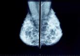 No surprises from the USPSTF with new guidance on screening mammography