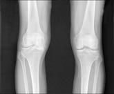 EULAR: Steroid injection accuracy may not matter for OA knee pain relief