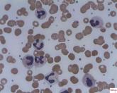 Mechanism proposed for microvascular thrombosis in thrombotic thrombocytopenic purpura